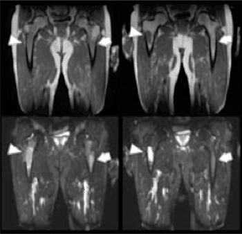 Image:  T1- and T2-weighted MR images of focal lesions before and after systemic treatment (Photo courtesy of Dr. Jens Hillengass, German Cancer Research Center in Heidelberg, Germany).